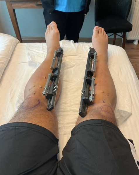 Мужчина потратил 100 тысяч евро, чтобы увеличить свой рост. «Вырос» до двух метров Мужчина потратил 100 тысяч евро, чтобы увеличить свой рост. «Вырос» до двух метров